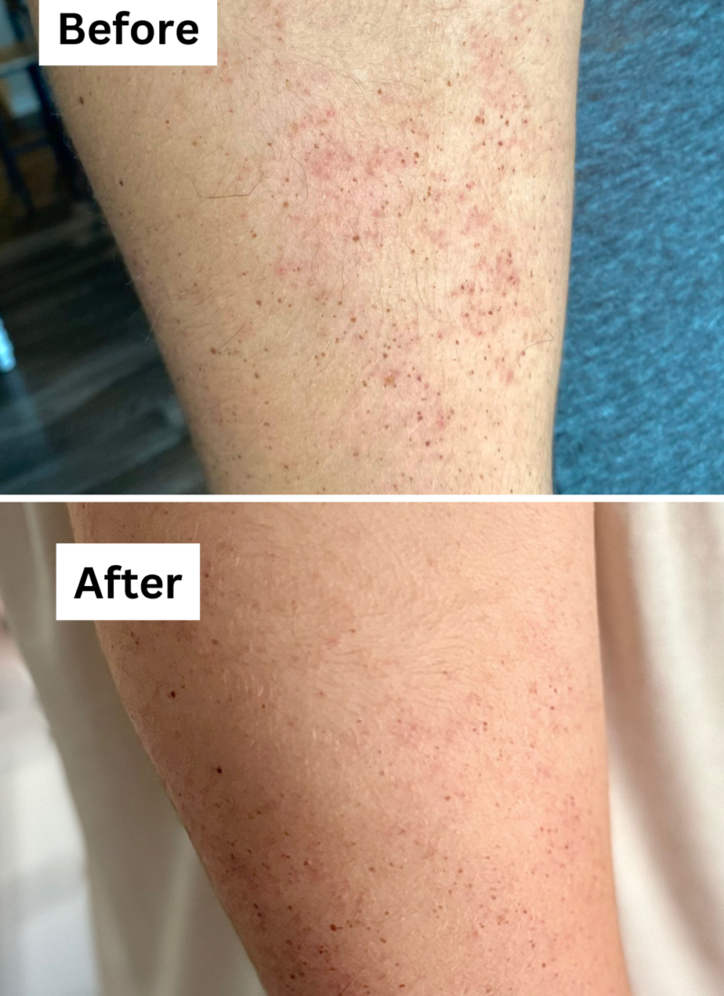 The Best Keratosis Pilaris Moisturizer That Will Leave Your Skin Clear And Glowing