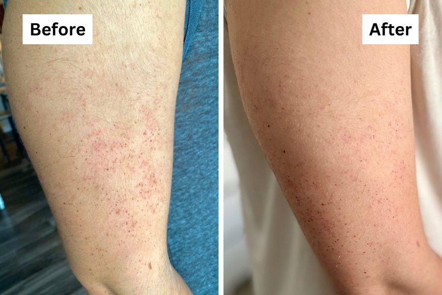 keratosis pilaris moisturizer