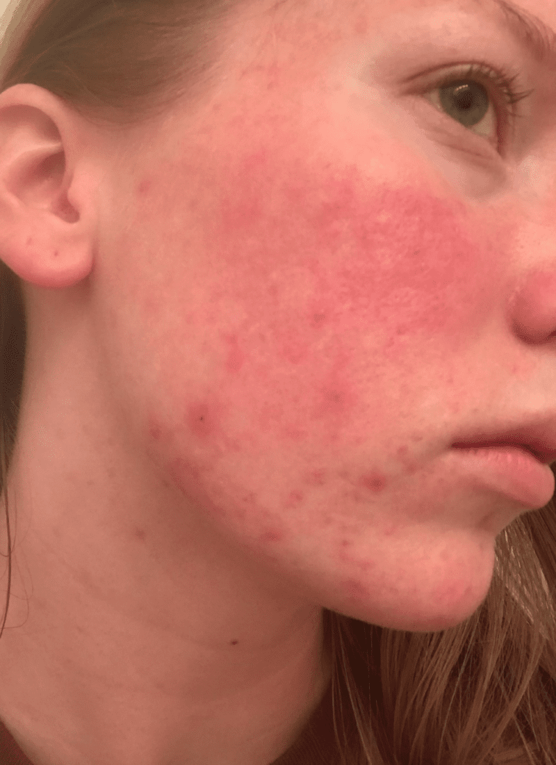 10 Best Acne Remedies To Clear Your Skin For Good