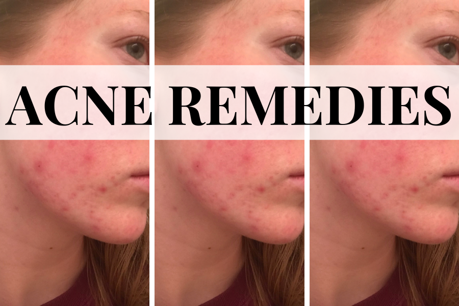 acne remedies