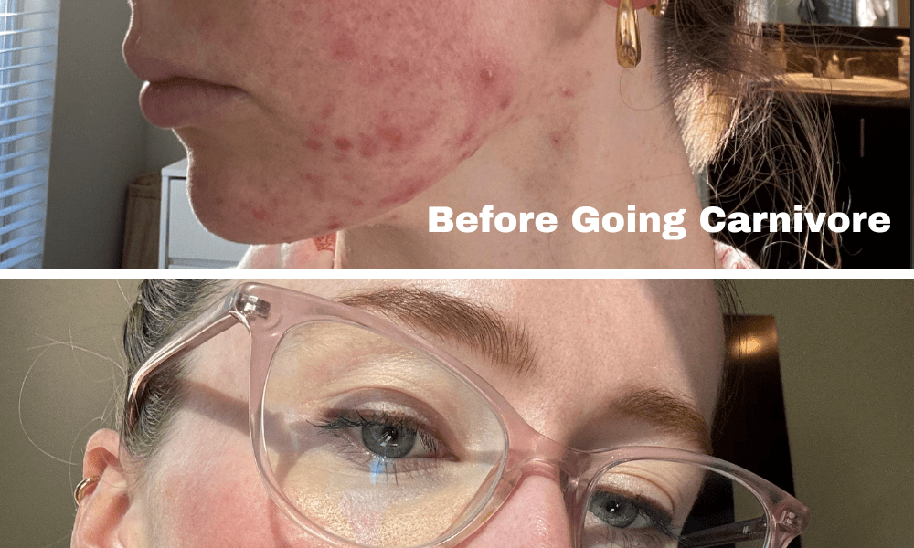 How I Got Rid Of My Acne By Going Carivore And You Can Too